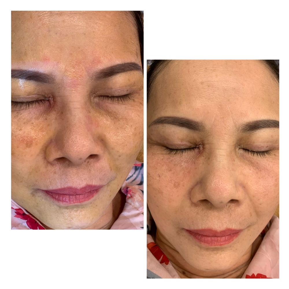 điều trị nám tàn nhang trước sau innoaesthetics