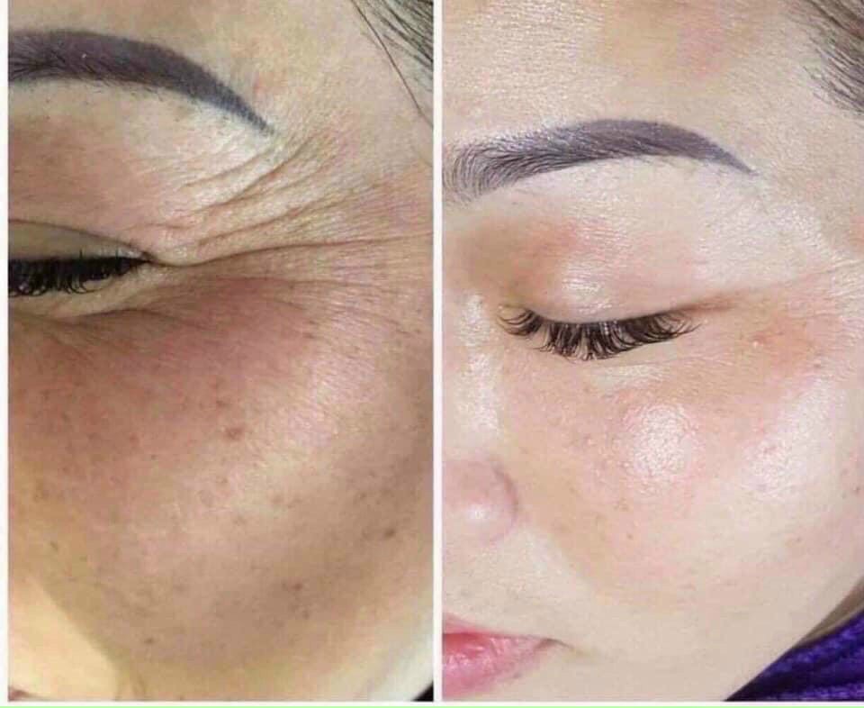 trước sau điều trị da lão hóa peel meso innoaesthetics