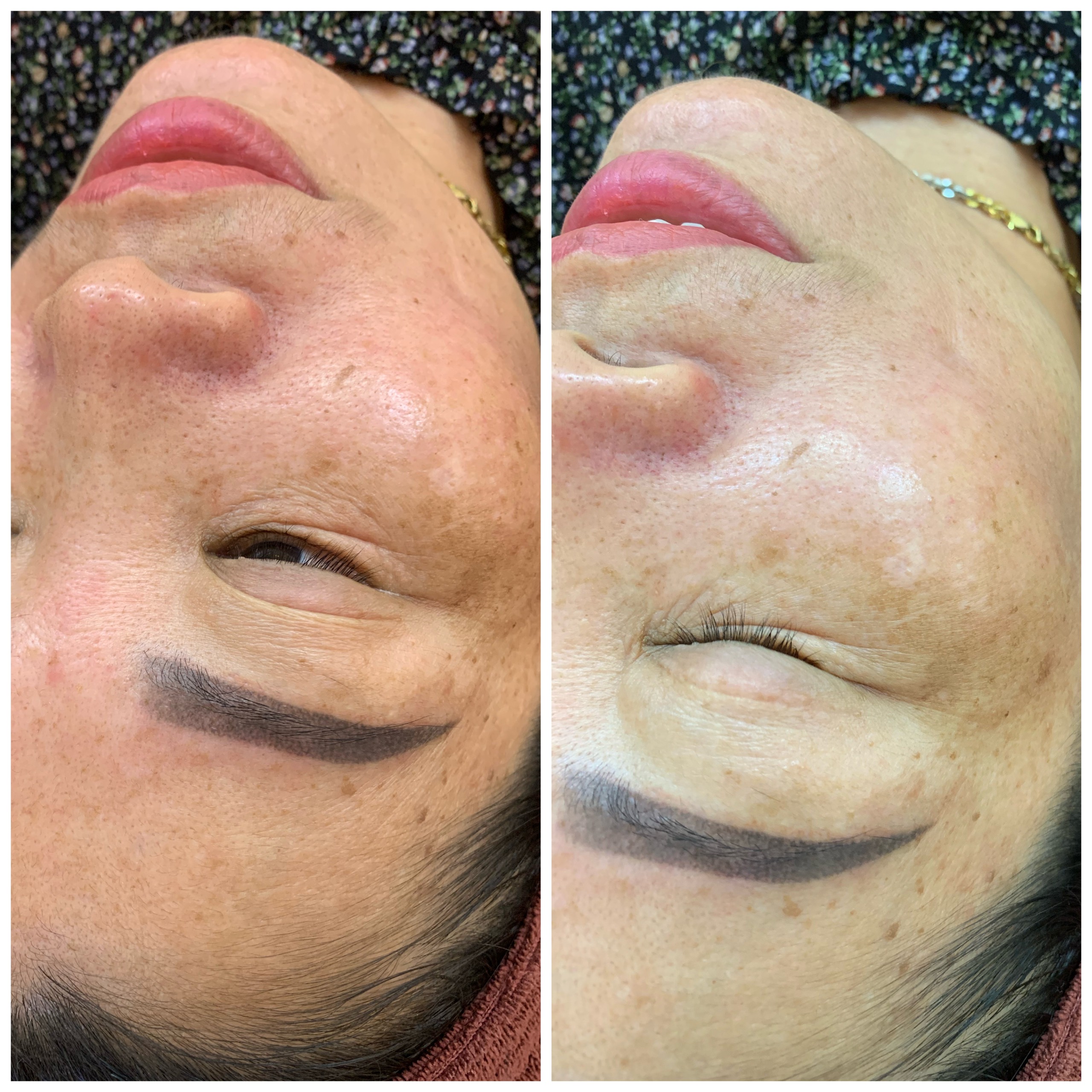 Meso Trị Nám: ME Line ID & Cơ Chế Ức Chế Melanin Từ Bên Tronginnoaesthetics-lip-recovery-skinrepair-peel-meso