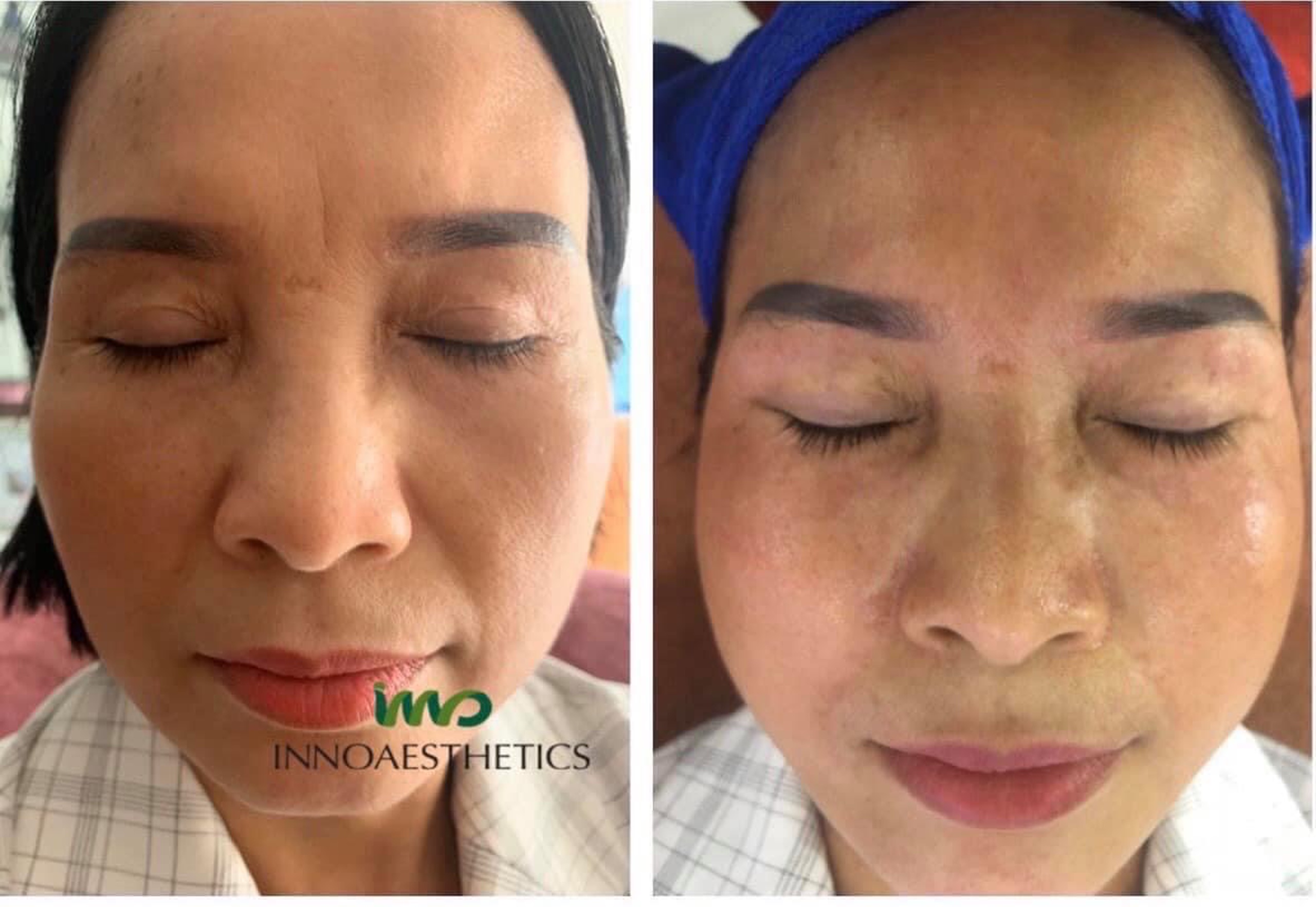 Skincare Đặc Trị Nám Tại Nhà