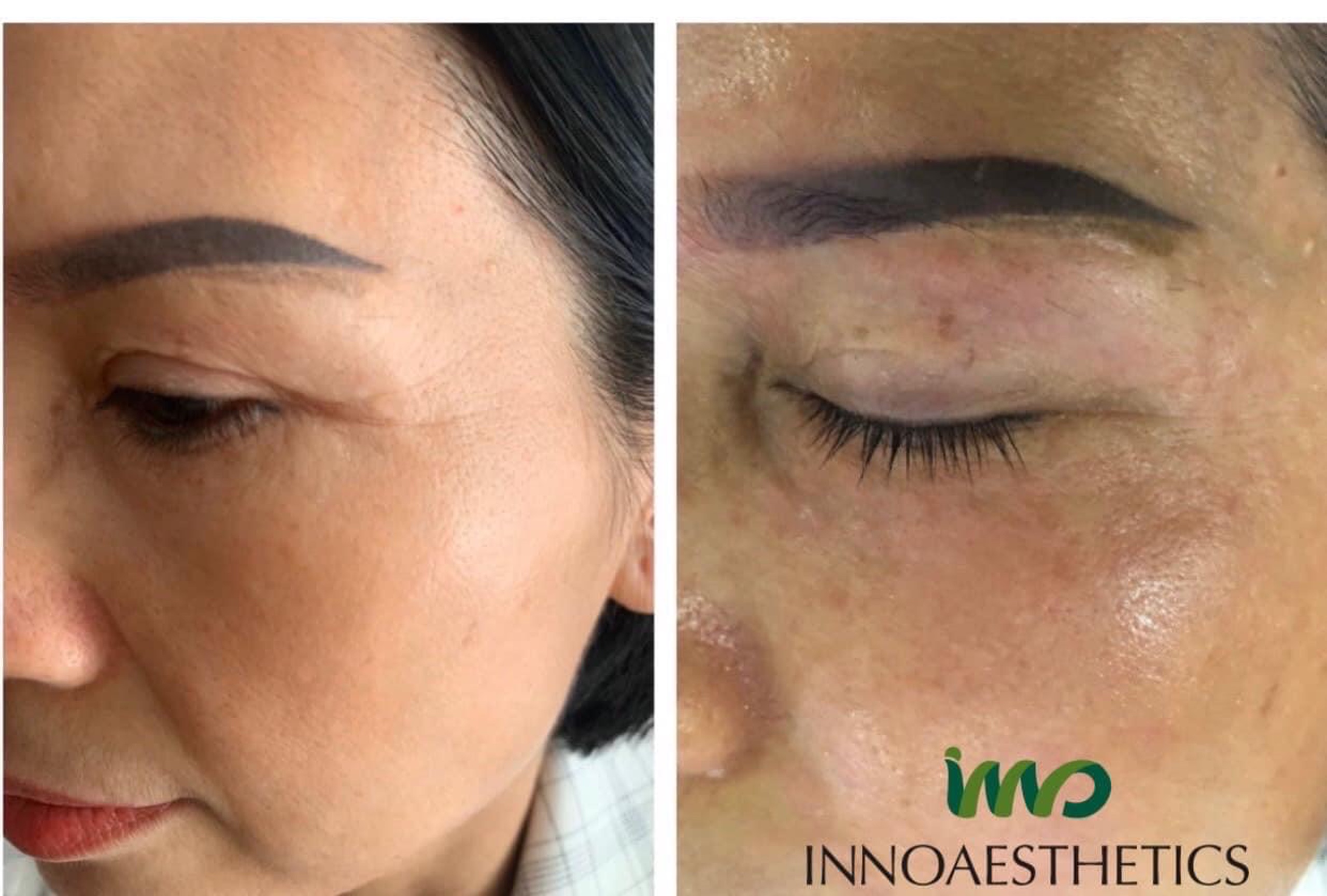 Peel Da Trị Nám: Phân Tích Hoạt Chất & Hiệu Quả Thực Tế