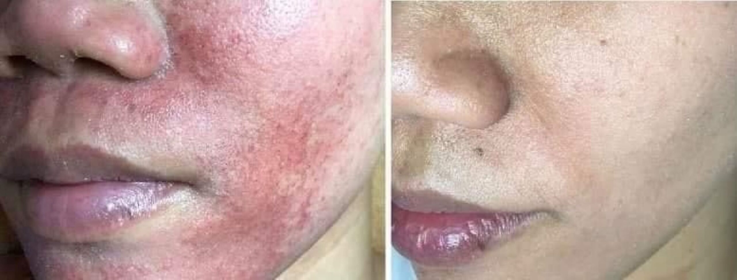 kết quả phục hồi da nhạy cảm kích ứng innoaesthetics