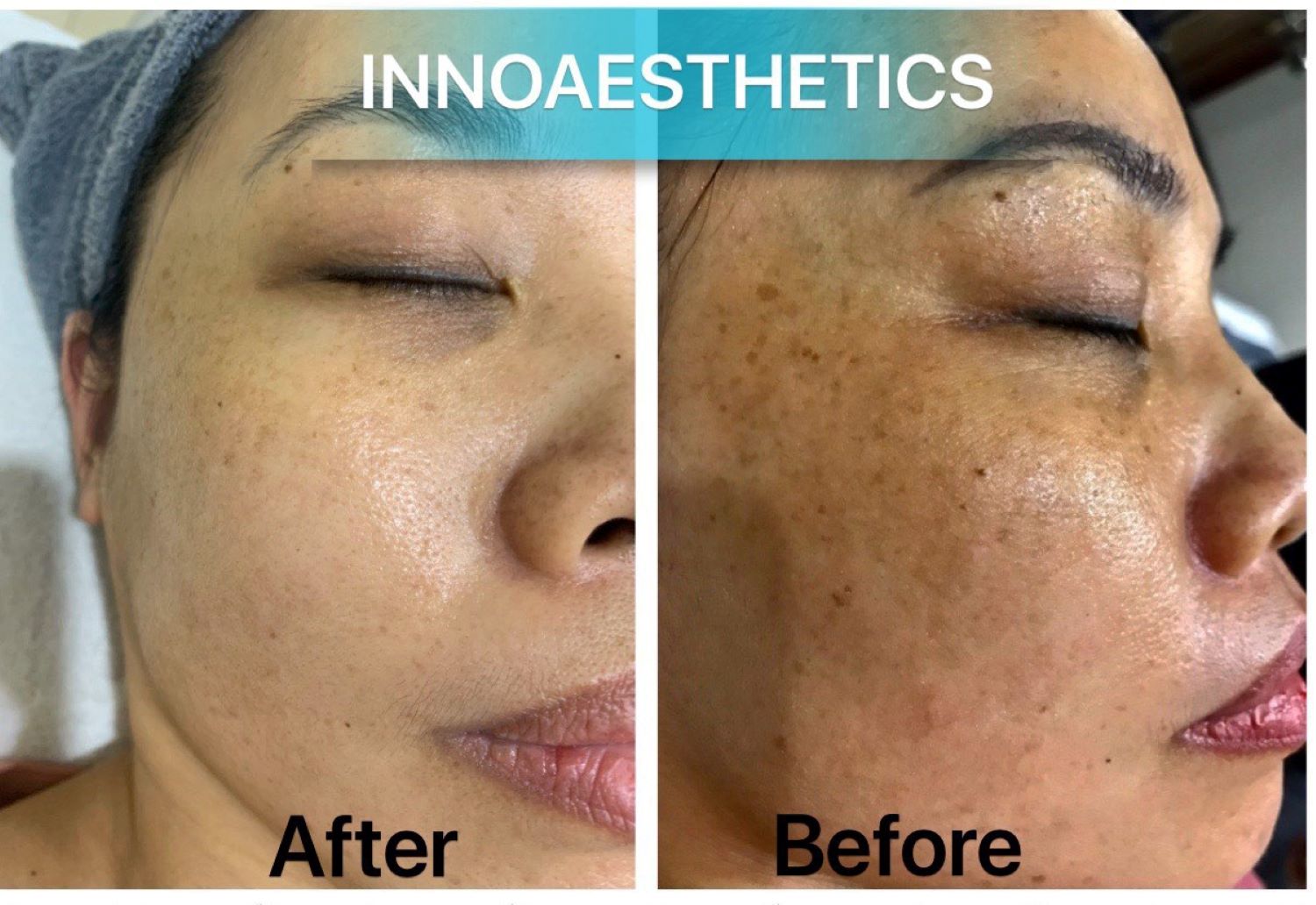 trước sau điều trị nám da innoaesthetics