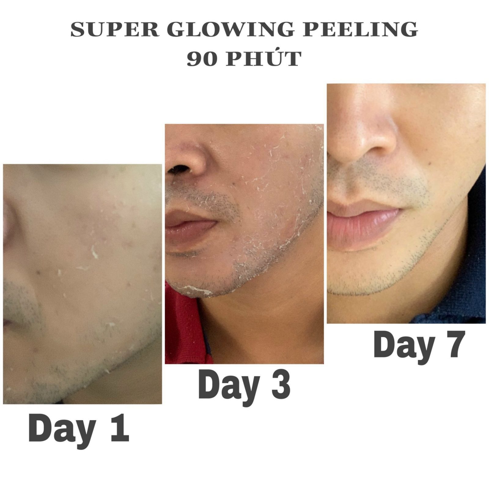 sản phẩm điều trị peel lightening A inno hiệu quả innoaesthetics-lip-recovery-skinrepair-peel-meso