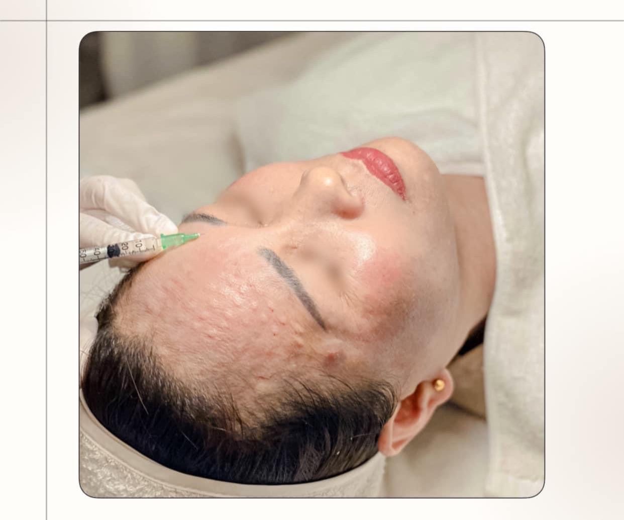 sản phẩm meso DNA điều trị căng bóng inno innoaesthetics-lip-recovery-skinrepair-peel-meso