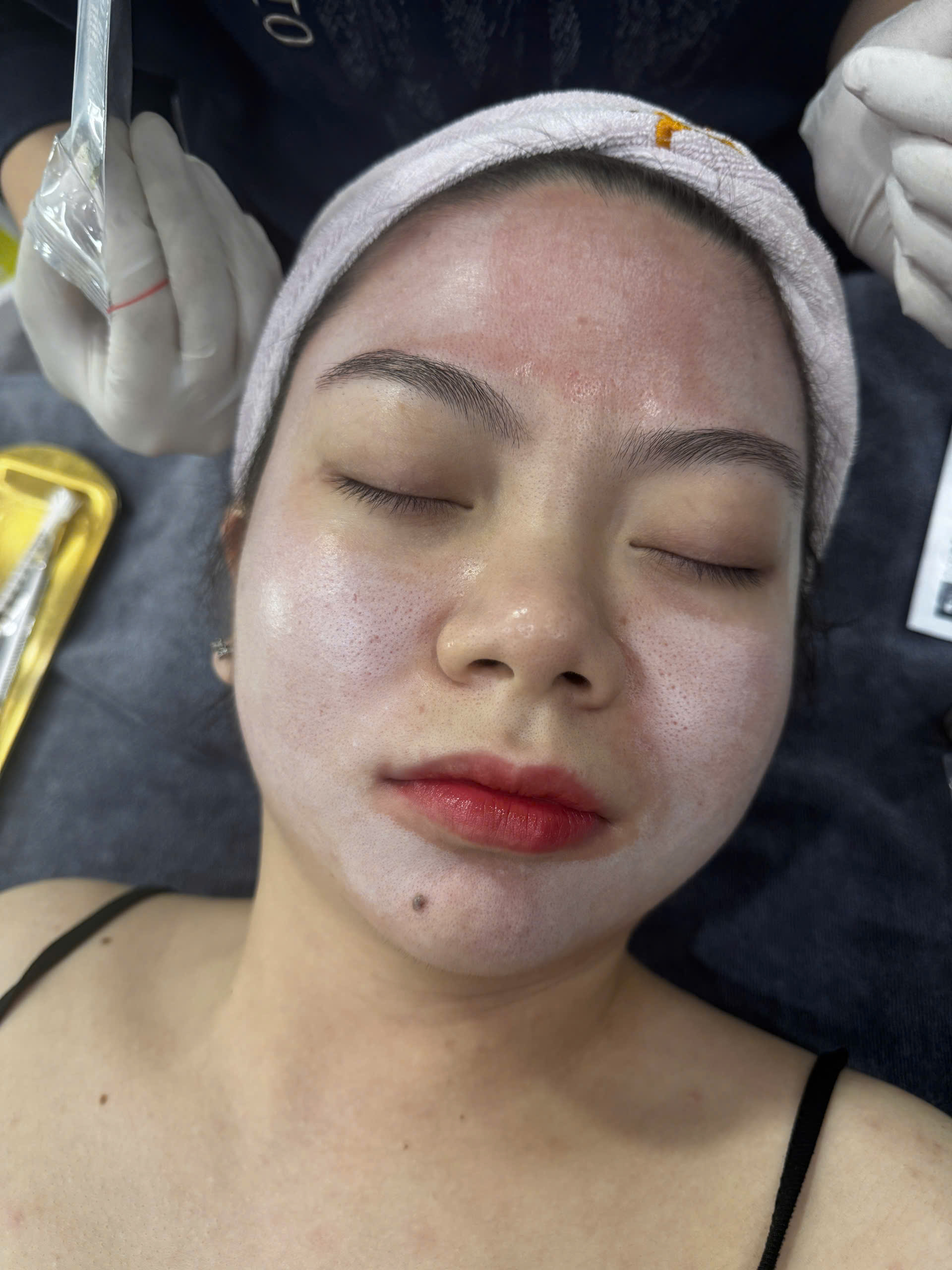 sản phẩm peel TCA 15% trẻ hóa da innoaesthetics INNO-EXFO TCAGE