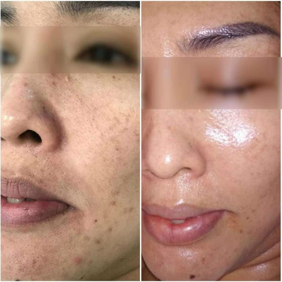 phục hồi da lão hóa skin repair age rescue innoaesthetics