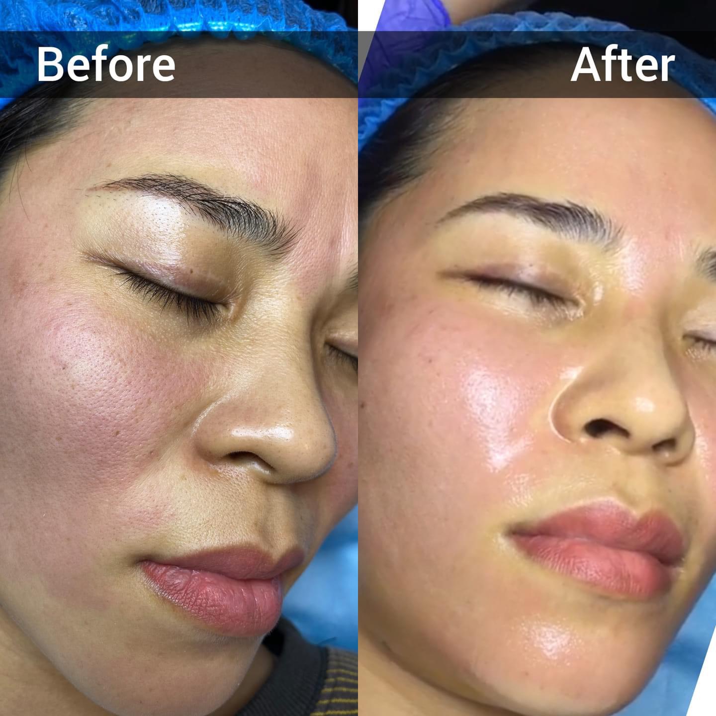 meso peel trẻ hóa làn da