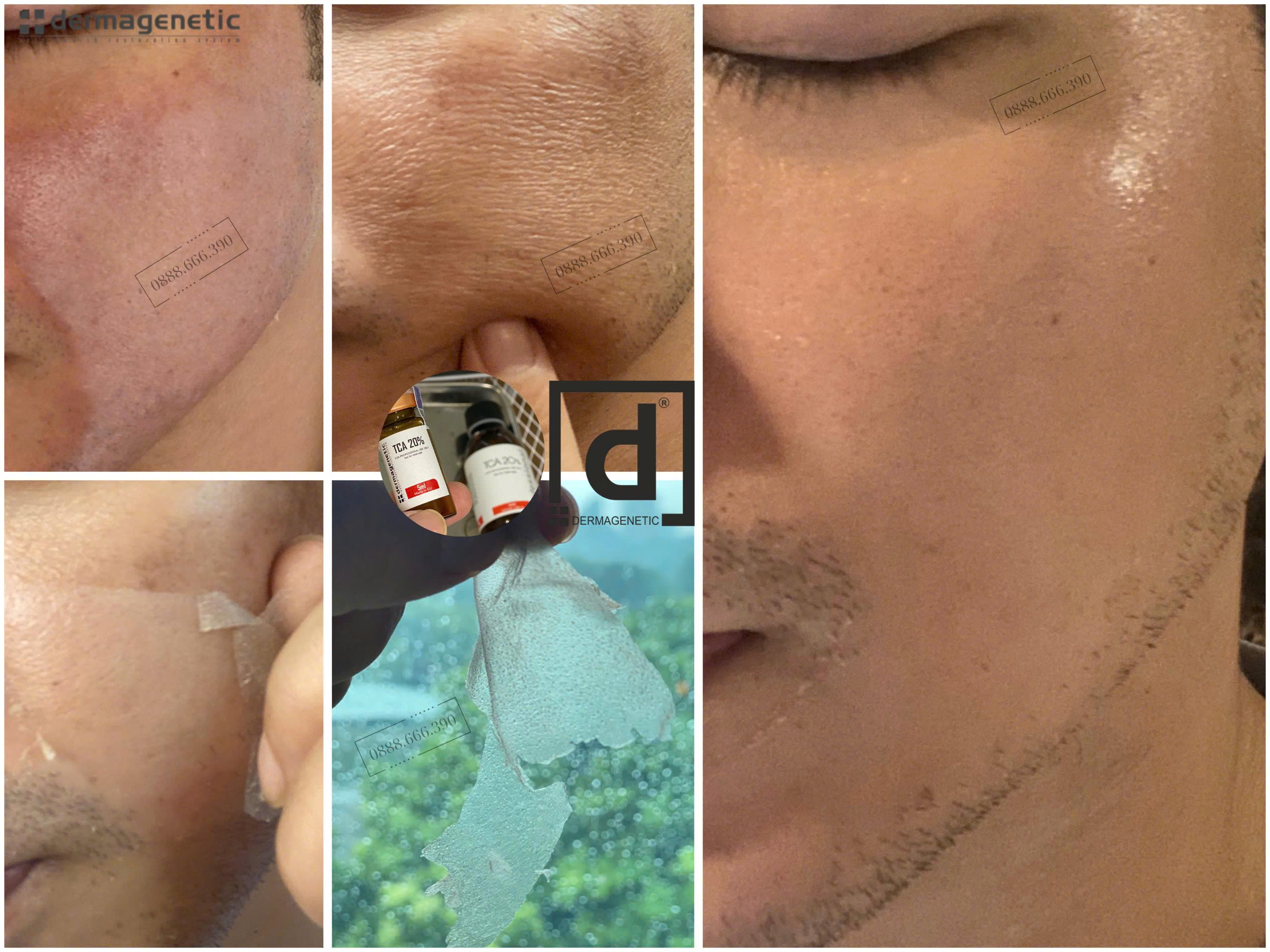da căng mịn sau peel trẻ hóa innoaesthetics