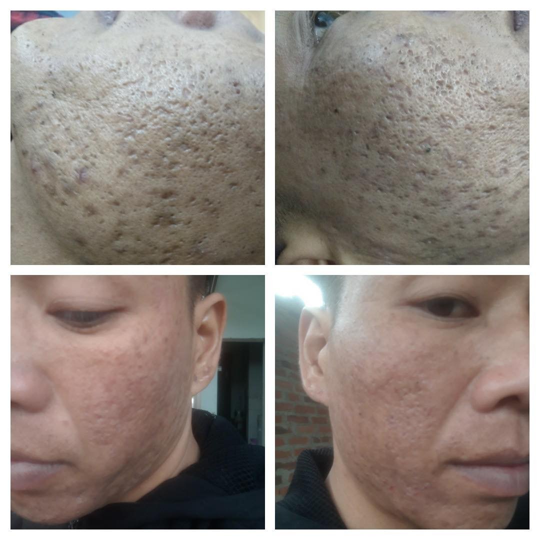 sẹo rỗ rolling scar điều trị peel TCA meso innoaesthetics