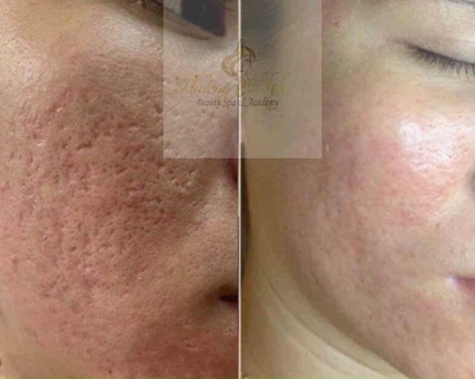 phục hồi sẹo rỗ boxcar peel meso innoaesthetics