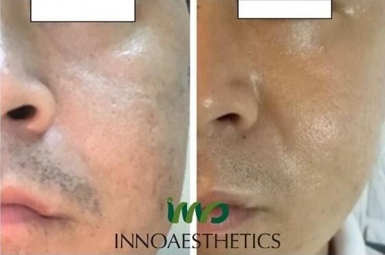 meso phục hồi sẹo rỗ trẻ hóa innoaesthetics kết quả