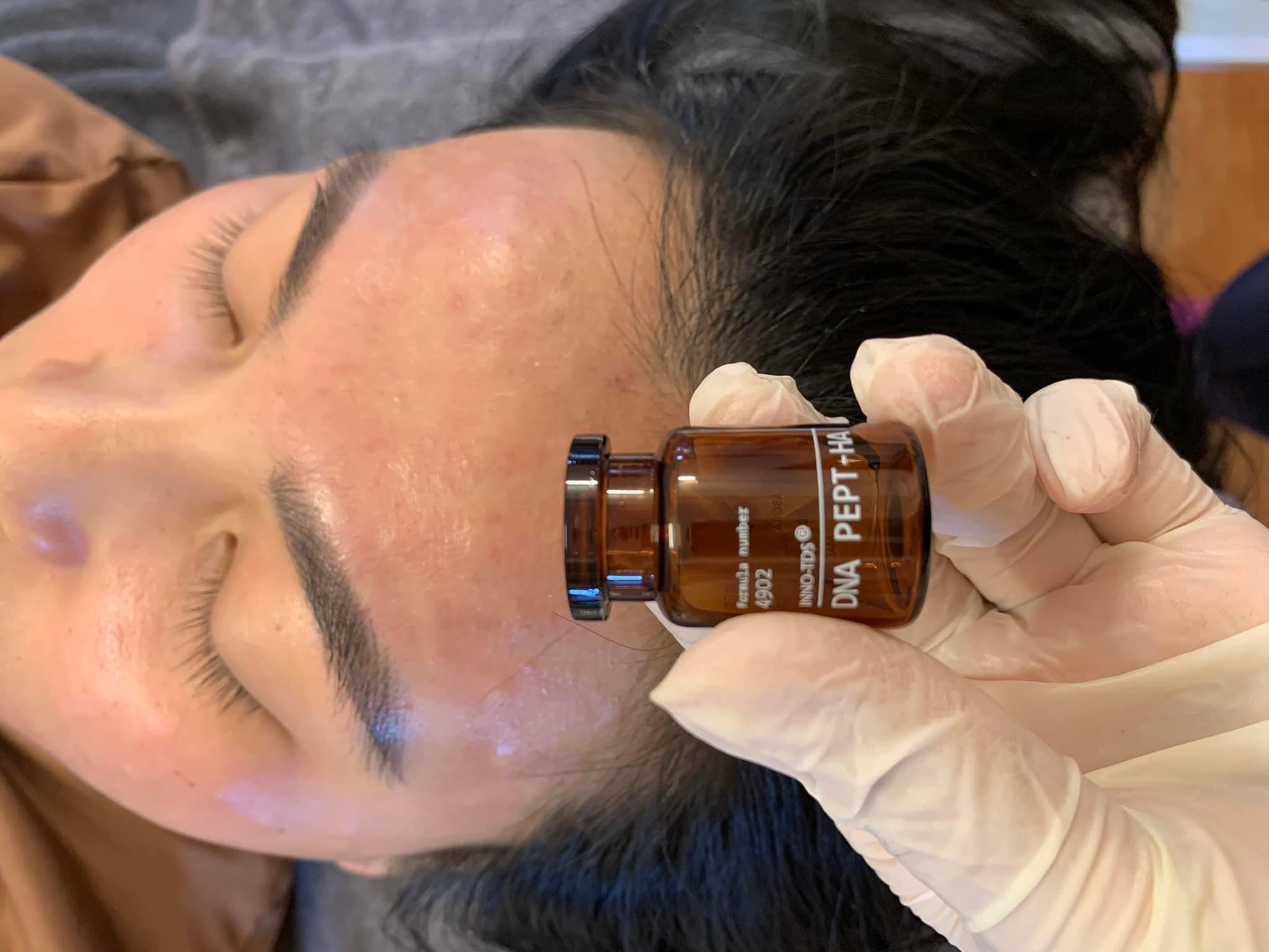điều trị trắng sáng da với meso dna innoaesthetics