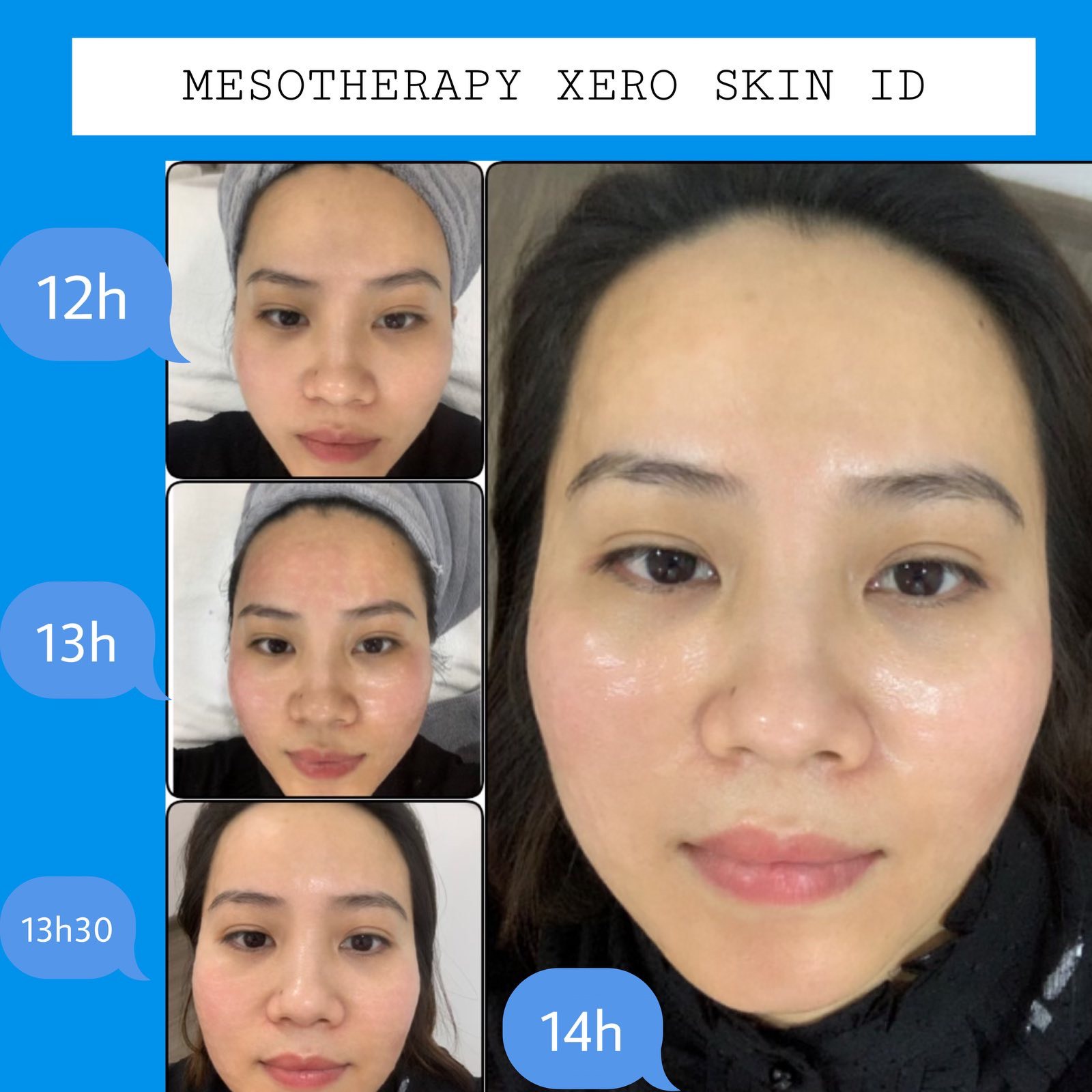 kết quả căng bóng trắng sáng sau điều trị innoaesthetics