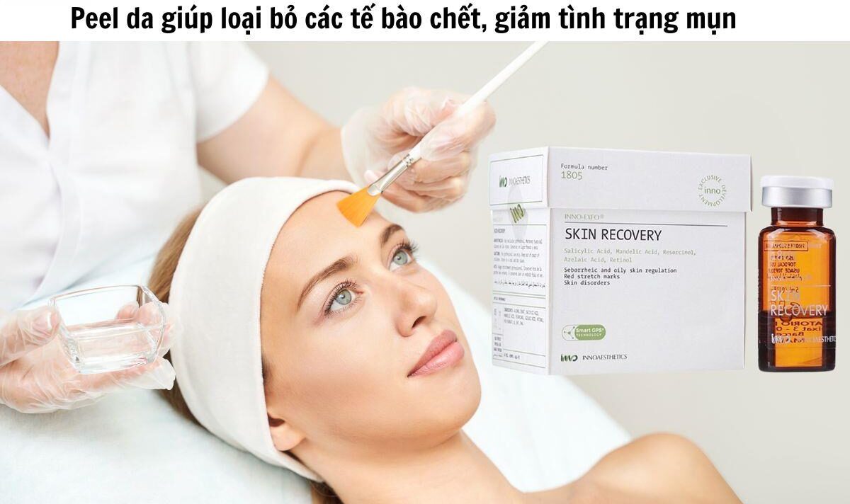 quy trình peel da trị mụn innoaesthetics